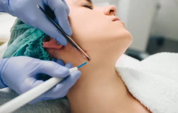 Is Mole Removal Right for You? What You Need to Know
