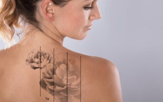 Can Laser Hair Removal Work on Tattooed Skin Without Issues?