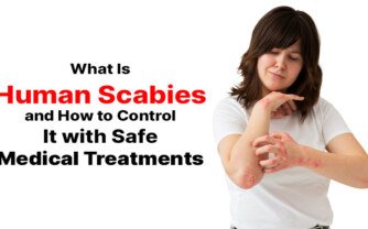What Is Human Scabies and How to Control It with Safe Medical Treatments