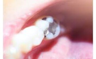 Can Mercury Vapor Be Inhaled During Removal?